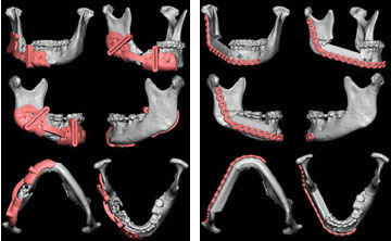 Three-dimensional CT scans are used with virtual surgical planning (VSP) to develop guides for facial reconstruction. The photo on the left depicts the cutting guide design, while the one on the right pinpoints the final position of plates.